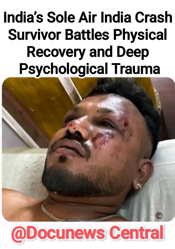 India’s Sole Air India Crash Survival Kumar’s Health Condition